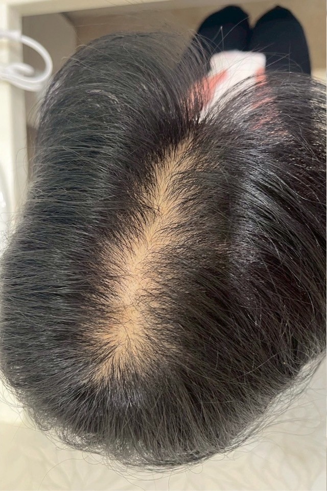 ビフォー（施術前）の分け目・頭頂部
